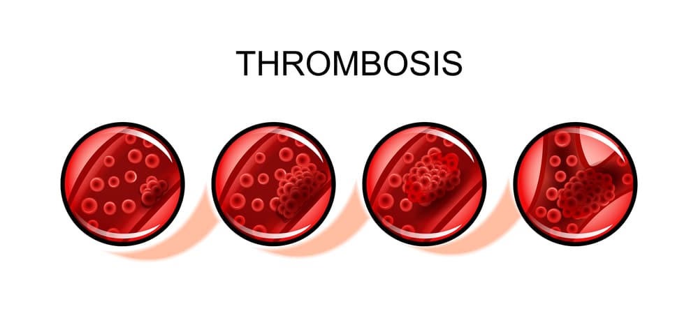 trombosis.jpg